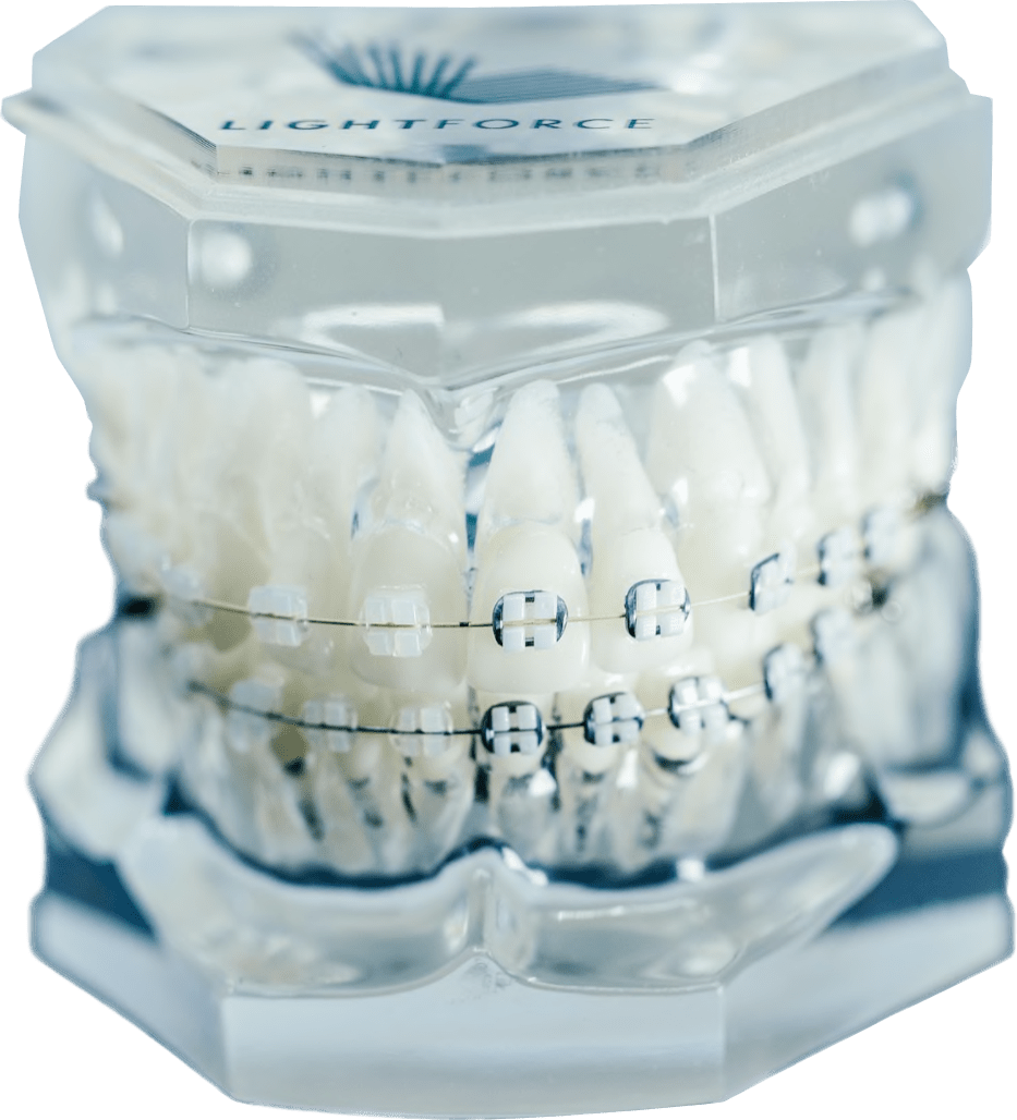 braces eagle mountain