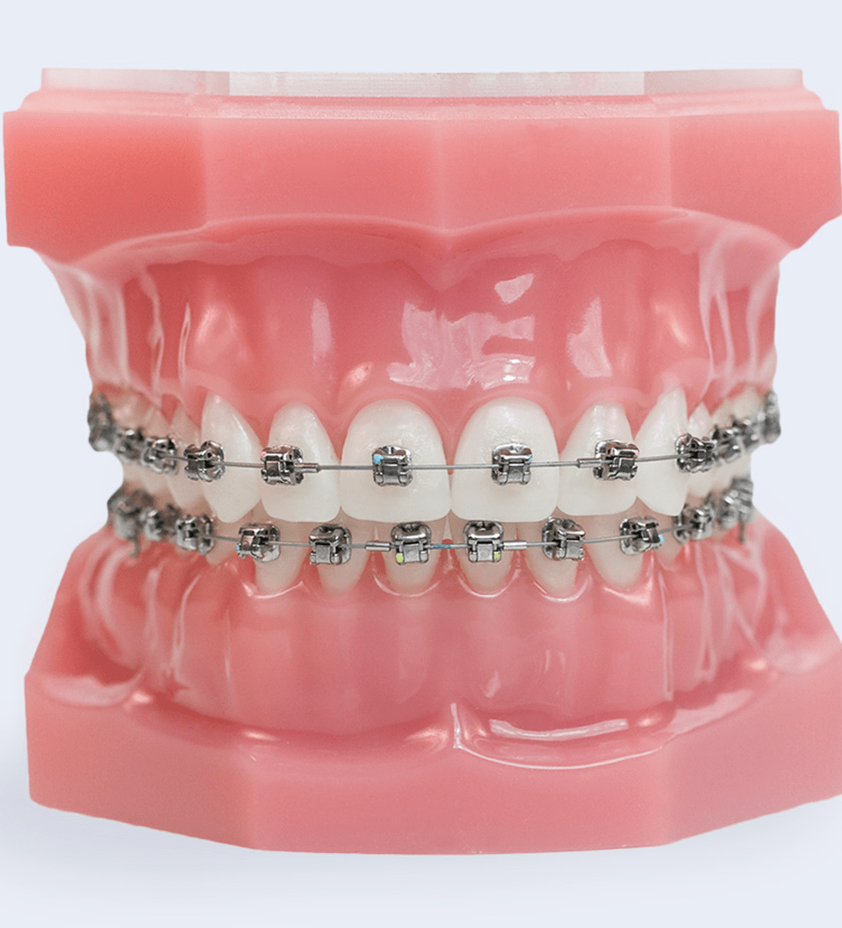 braces eagle mountain