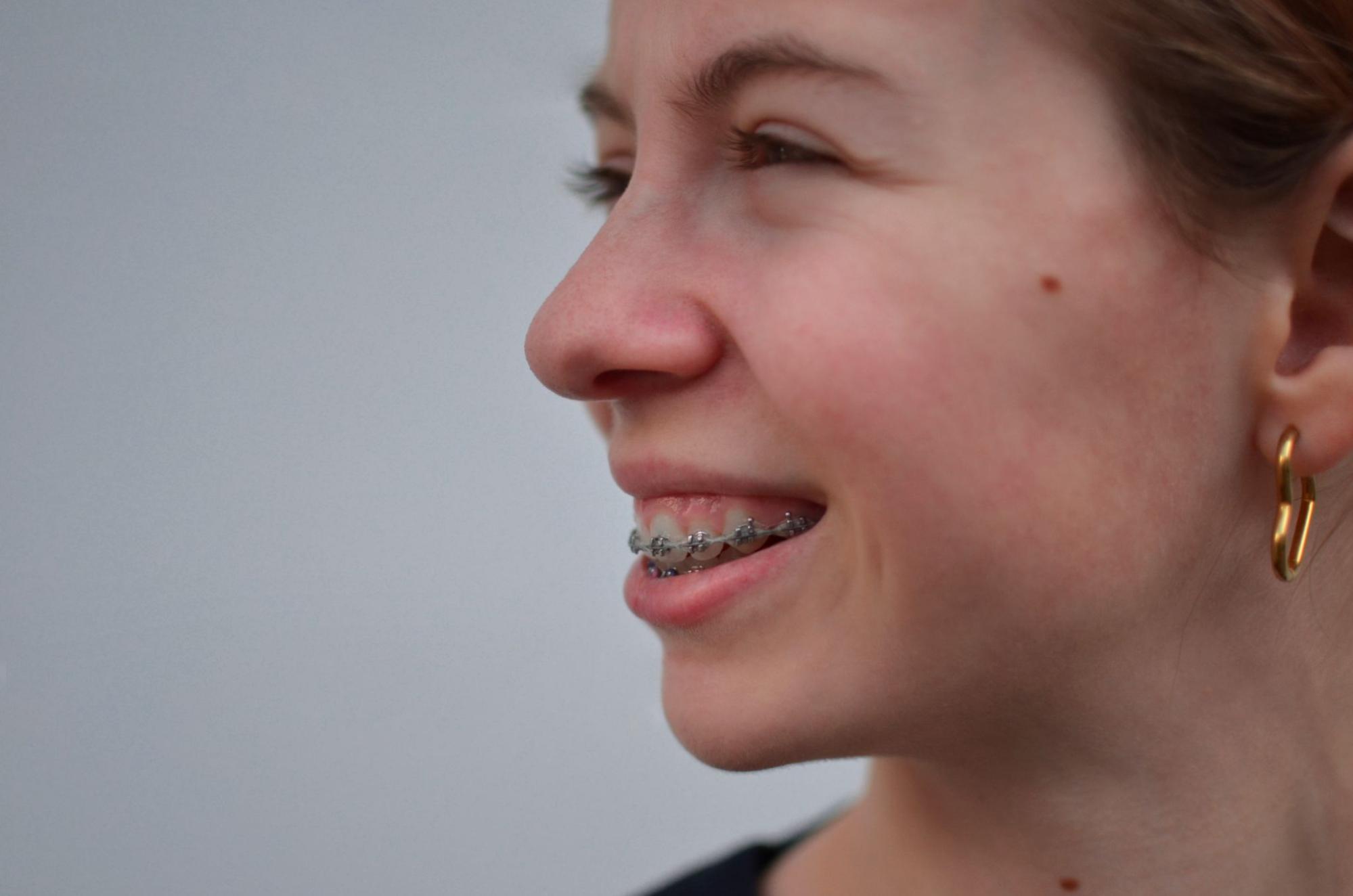 Teen girl with braces smiling, showcasing orthodontic treatment for improved smile aesthetics related to gummy smile concerns.