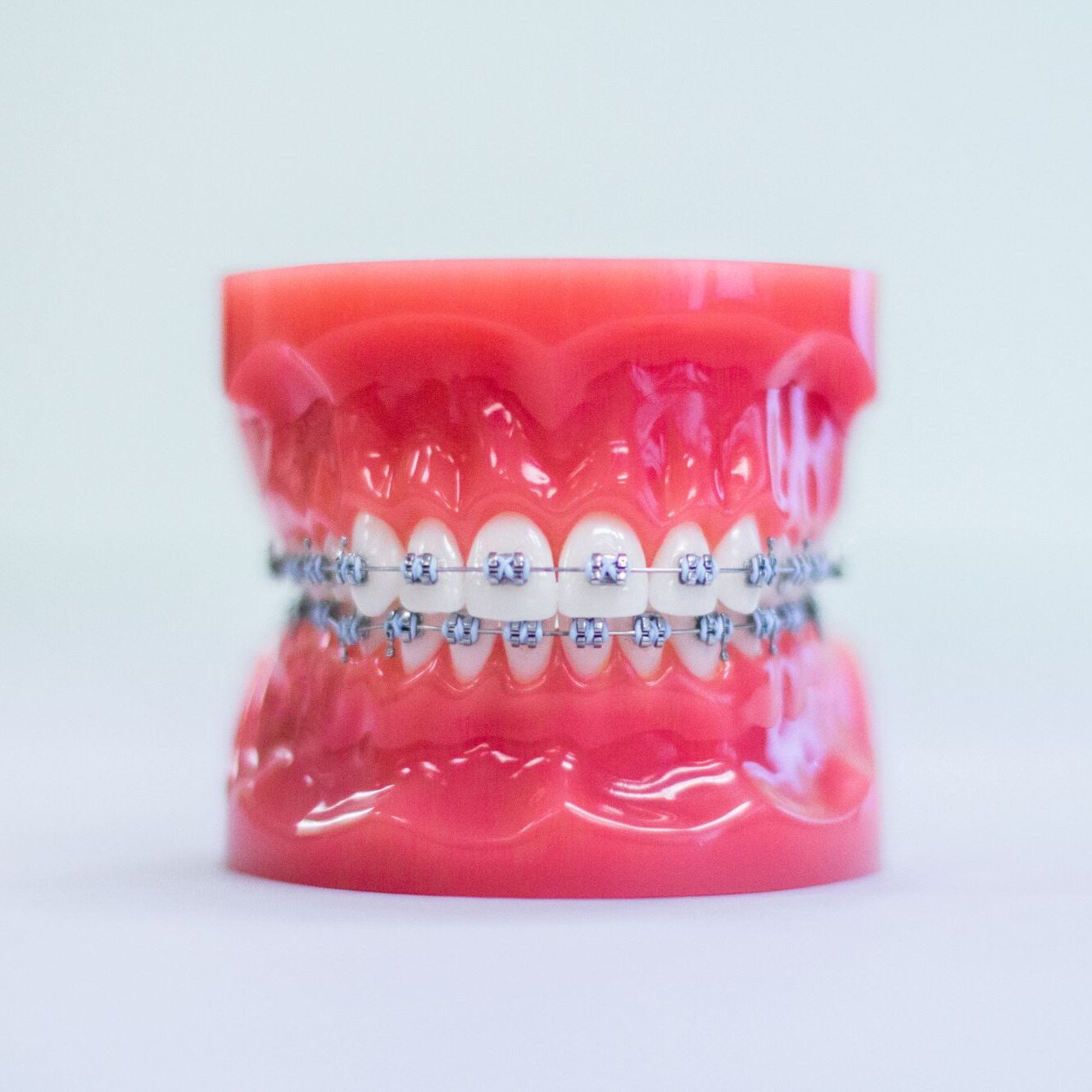 Model of teeth with Damon self-ligating braces, showcasing orthodontic treatment options at White Orthodontics in Eagle Mountain.